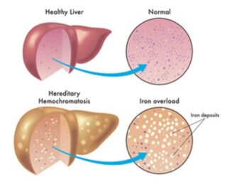 Cartoon image depicting healthy liver compared to a liver affected by hereditary hemochromatosis.